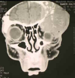 CT scan image showing a sphenoid wing meningioma